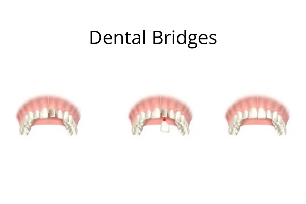 Dental Bridges