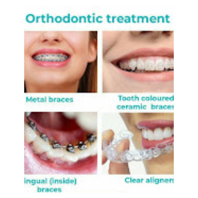 Types of Orthodontic Treatments – Braces and Aligners Types of Braces and Aligners – Orthodontic Treatment Options