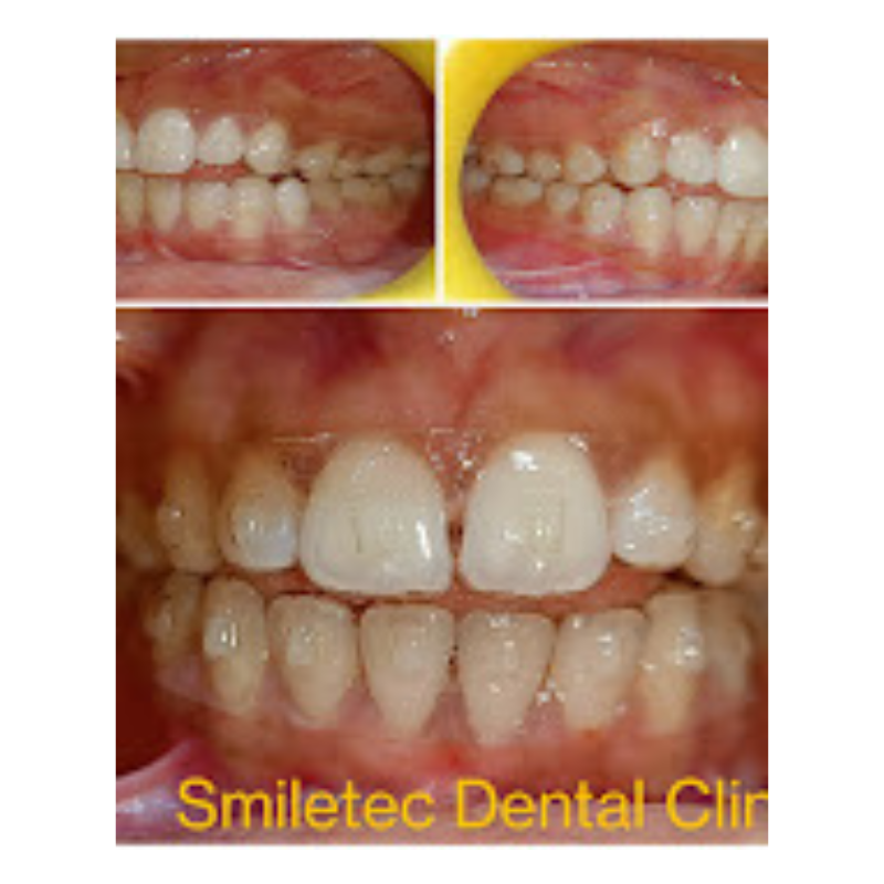 Braces Progress - Pre, Mid, and Post Treatment braces-progress-pre-mid-post