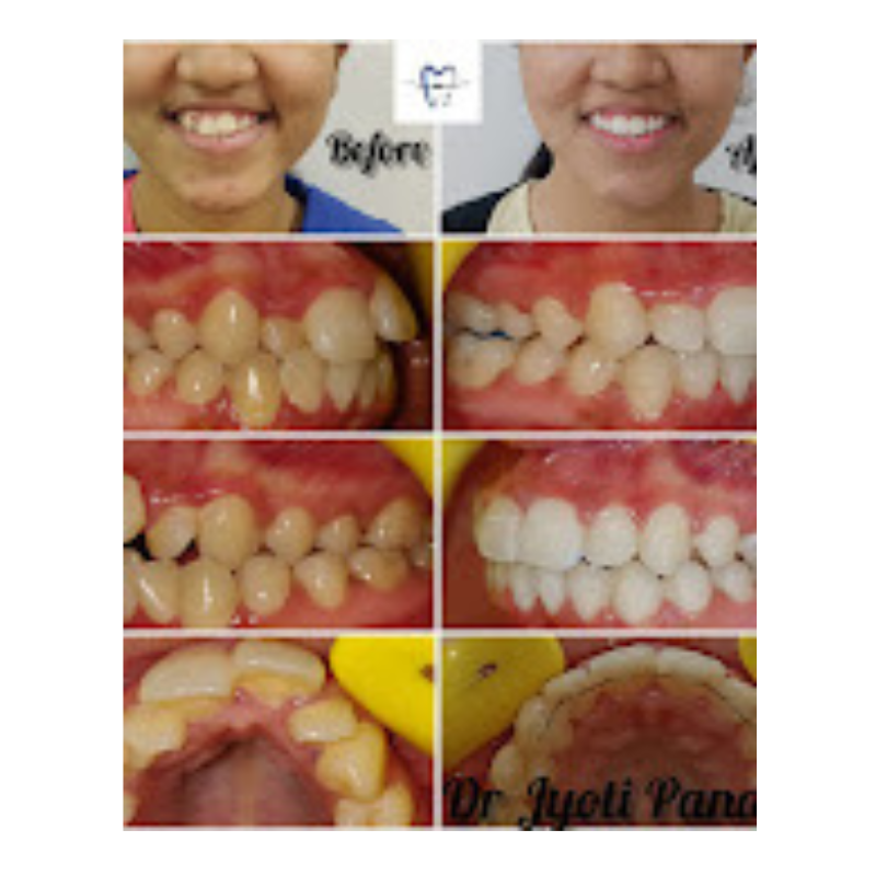 Complete Orthodontic Case – Smile & Bite Correction Before & After Full Orthodontic Smile Makeover – Before and After by Dr. Jyoti Pandey