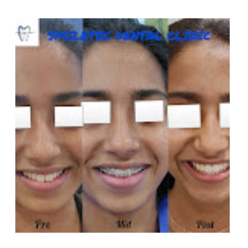 Braces Journey – Pre, Mid & Post Smile Transformation Braces Smile Transformation – Before, During & After at Smiletec Dental Clinic