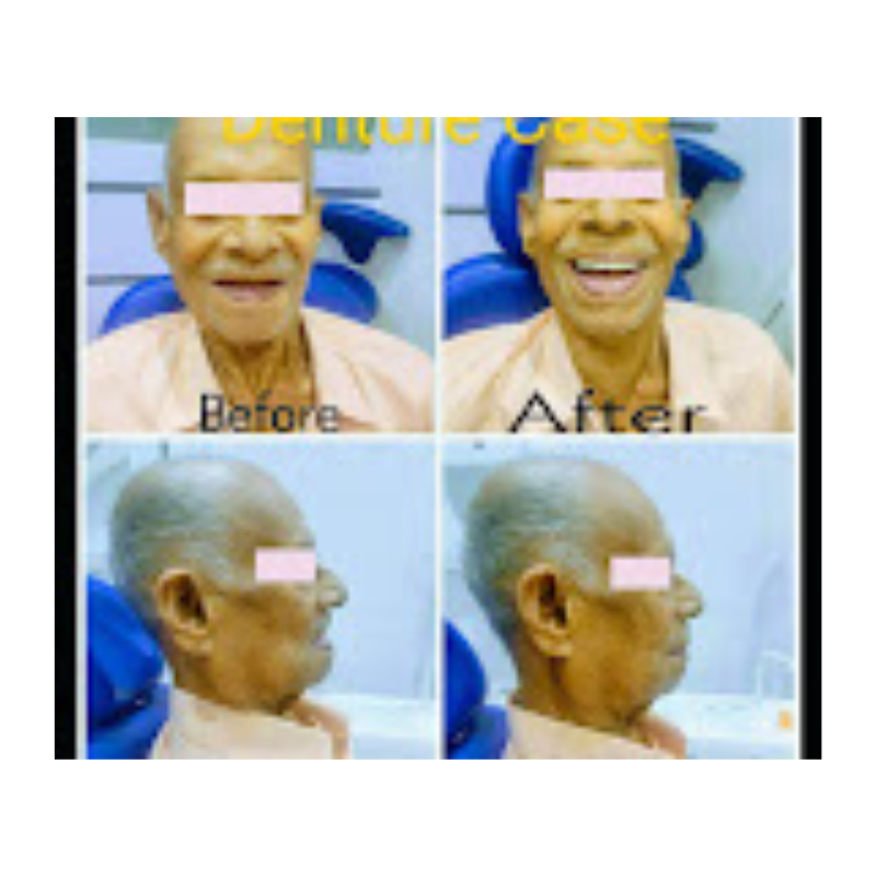 Untitled design (23) Full Denture Smile Makeover – Before and After by Smiletec Dental