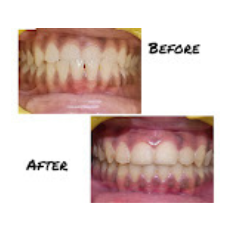 Midline Diastema Closure – Before & After Smile Correction Diastema Gap Closure – Smile Correction Before and After Result</p>
<p>