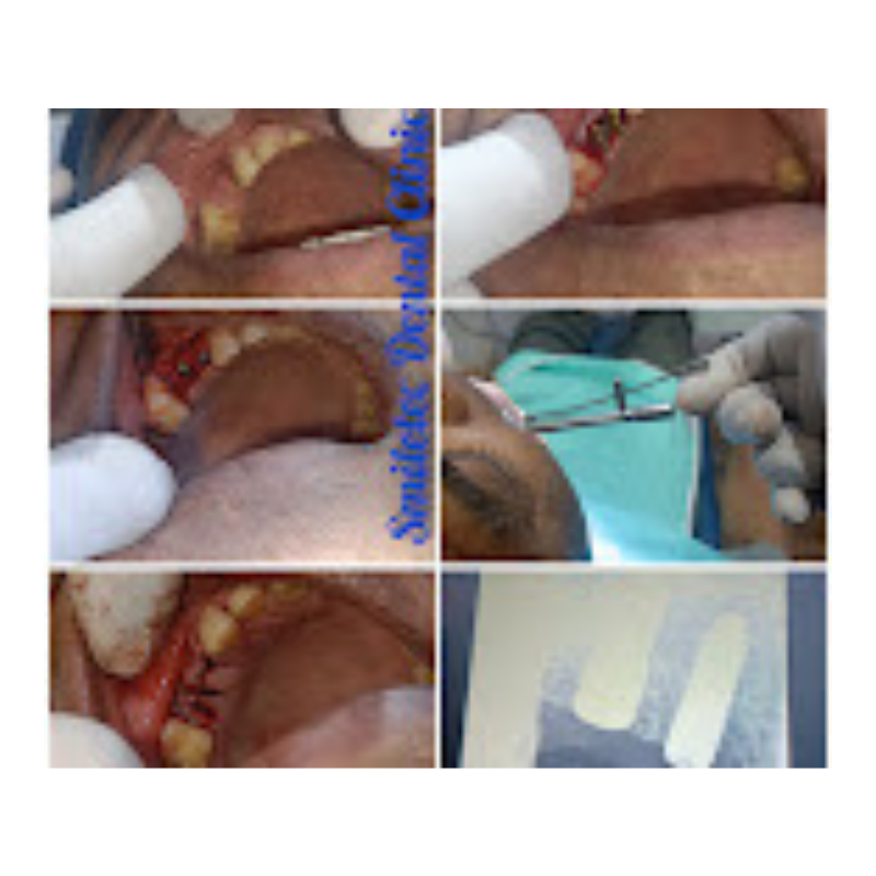 Minor Oral Surgery Procedure – Clinical Steps at Smiletec Dental Clinic Safe & Painless Oral Surgery at Smiletec Dental Clinic – Procedure Overview