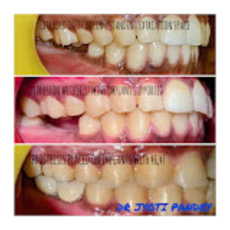 Dental Alignment Correction – Before and After Clinical Progress dental-alignment-before-after-dr-jyoti-pandey