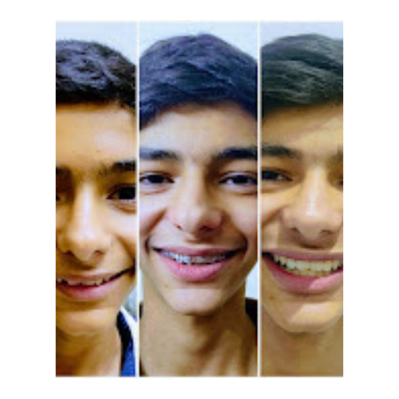 Braces Transformation Journey – Before & After Smile Makeover braces-smile-transformation-before-after