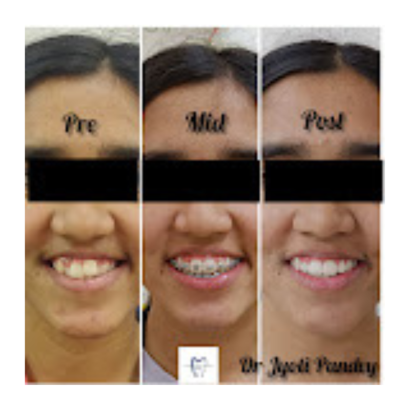 Complete Braces Journey – Pre, Mid & Post Treatment Full Braces Transformation – Before, During & After by Dr. Jyoti Panandy