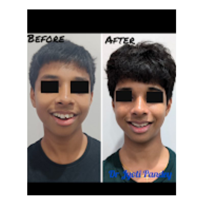 Braces Progress - Pre, Mid, and Post Treatment braces-progress-pre-mid-post