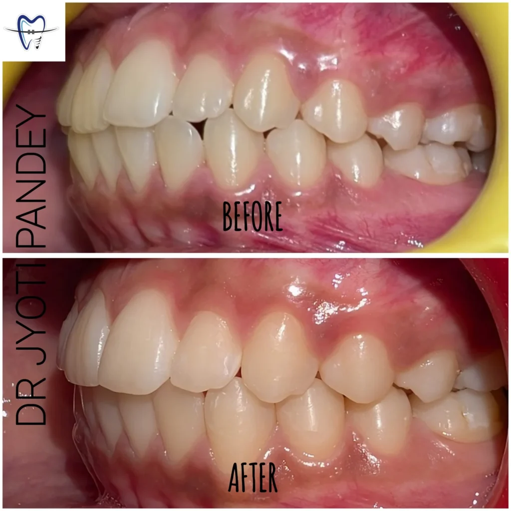 Before and After Orthodontic Treatment Image | Dr. Jyoti Pandey