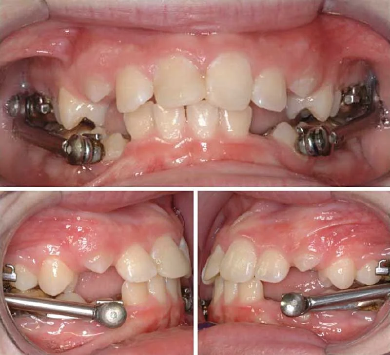 Functional Appliances for Jaw Growth in Orthodontics