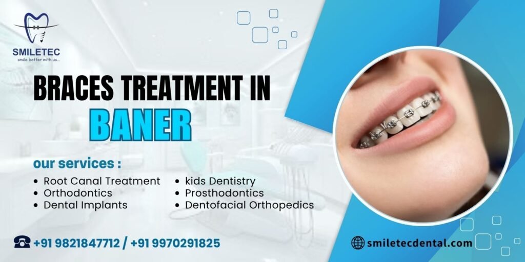 Braces treatment in Baner