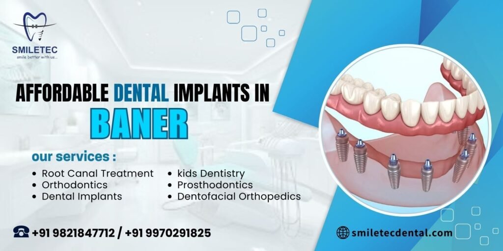 Affordable dental implants in Baner