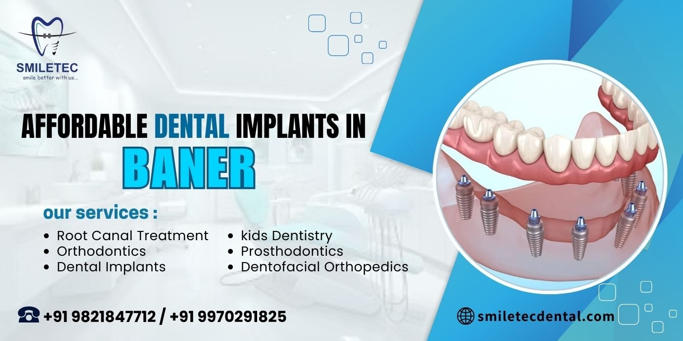 Affordable dental implants in Baner