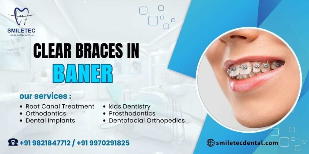 Clear braces in Baner
