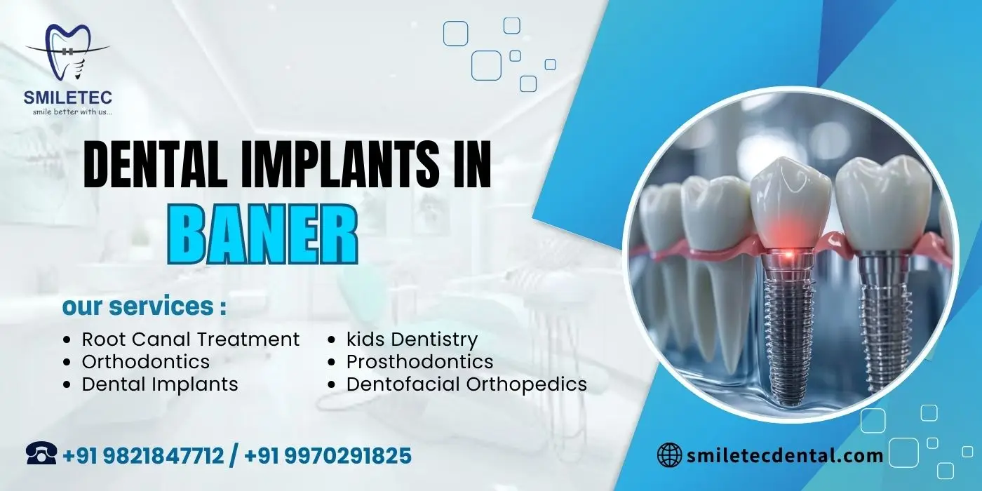 Dental implants in Baner