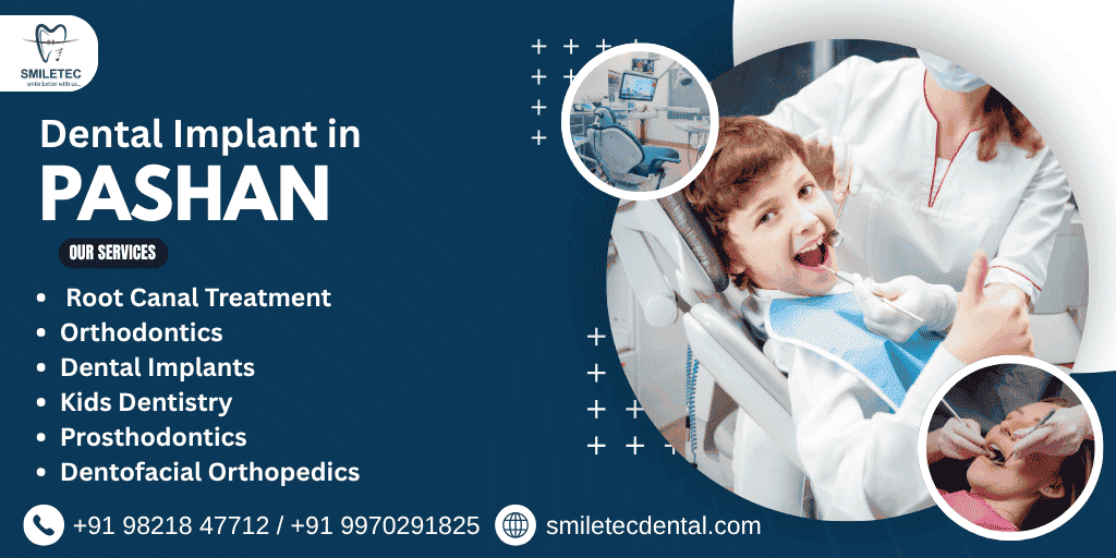 Dental Implant in Pashan
